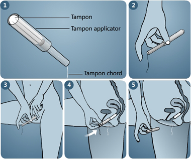 Illustration of steps showing the usage of tampon with applicator, step 1: the tampon is in the bigger tube of the applicator with its string hangin out of the smaller tube, step 2: The applicator held between the thumb and the middle finger, step 3: The bigger end of the tampon applicator is inserted in the vagina while the legs are spread apart, step 4: The smaller tube is pushed by the index finger to push the tampon in place in the vagina, step 5: applicator is removed while the string of the tampon is left hanging - Menstrupedia